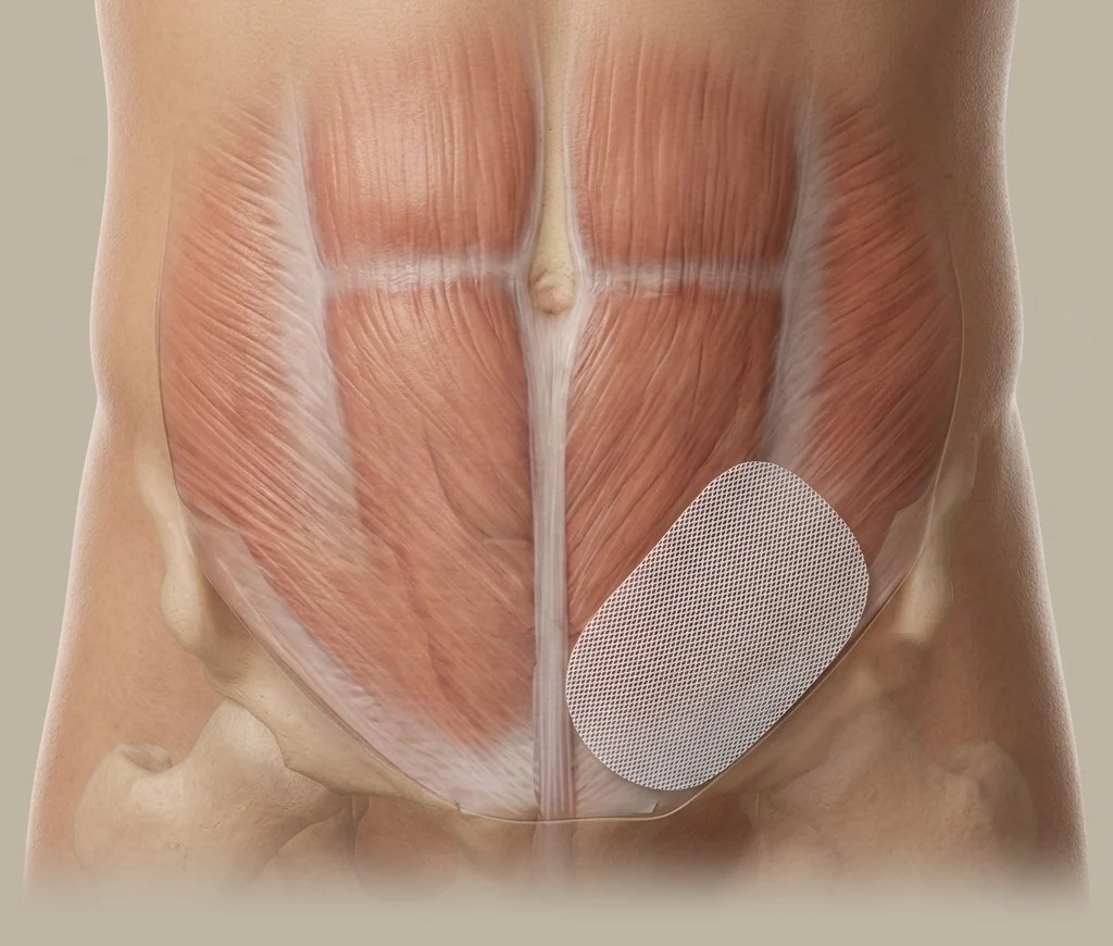 A see-through view of a man's lower abdomen showing the muscle wall and a flat sheet of mesh over the weak spot in the left groin